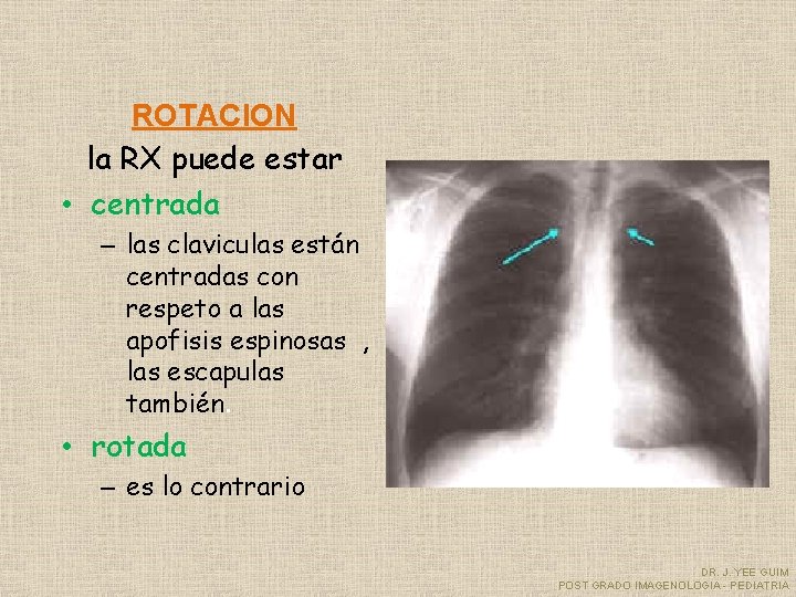 ROTACION la RX puede estar • centrada – las claviculas están centradas con respeto