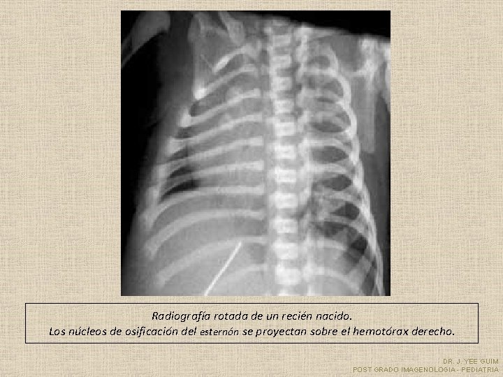 Radiografía rotada de un recién nacido. Los núcleos de osificación del esternón se proyectan