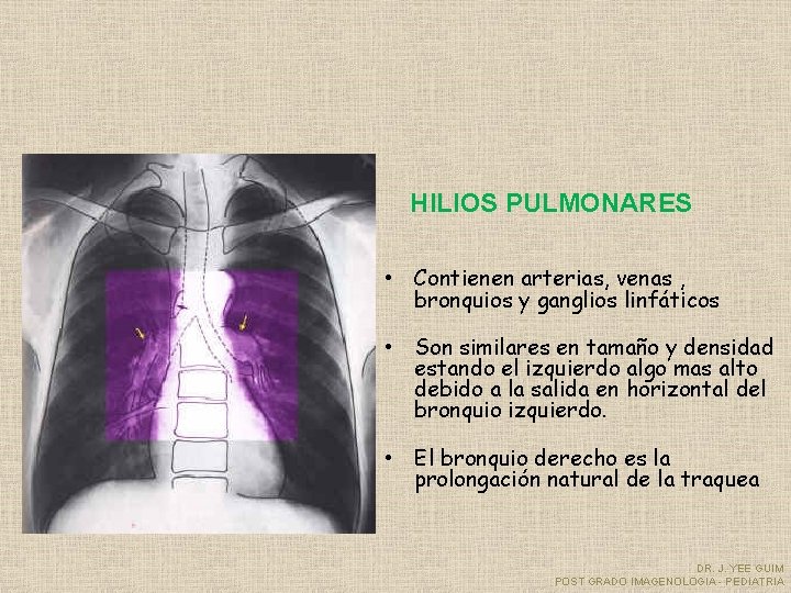 HILIOS PULMONARES • Contienen arterias, venas , bronquios y ganglios linfáticos • Son similares