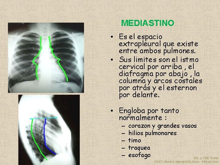 MEDIASTINO • Es el espacio extrapleural que existe entre ambos pulmones. • Sus limites