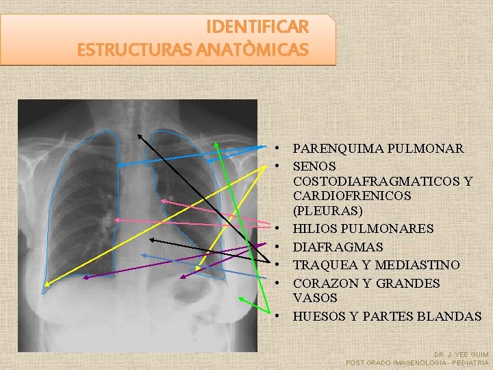 IDENTIFICAR ESTRUCTURAS ANATÒMICAS • PARENQUIMA PULMONAR • SENOS COSTODIAFRAGMATICOS Y CARDIOFRENICOS (PLEURAS) • HILIOS