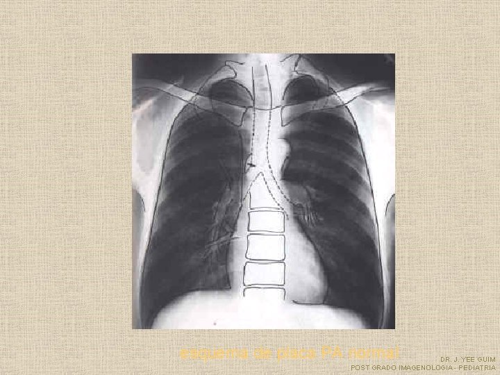 esquema de placa PA normal DR. J. YEE GUIM POST GRADO IMAGENOLOGIA - PEDIATRIA