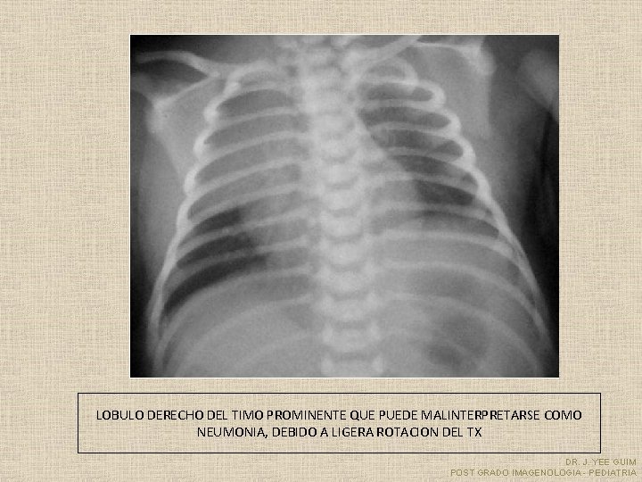 LOBULO DERECHO DEL TIMO PROMINENTE QUE PUEDE MALINTERPRETARSE COMO NEUMONIA, DEBIDO A LIGERA ROTACION