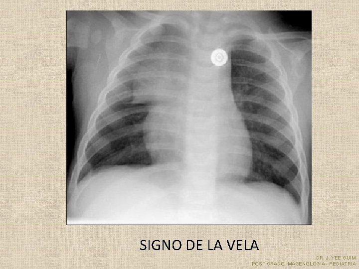 SIGNO DE LA VELA DR. J. YEE GUIM POST GRADO IMAGENOLOGIA - PEDIATRIA 