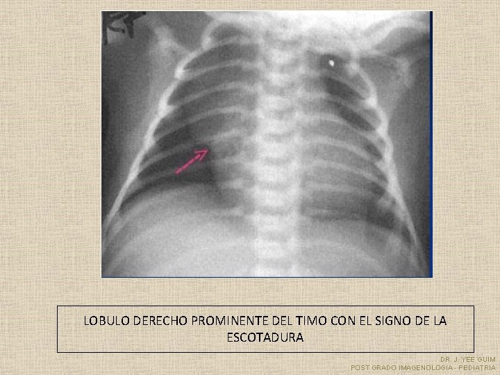 LOBULO DERECHO PROMINENTE DEL TIMO CON EL SIGNO DE LA ESCOTADURA DR. J. YEE