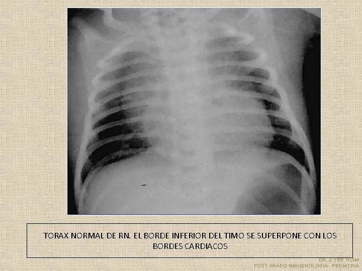TORAX NORMAL DE RN. EL BORDE INFERIOR DEL TIMO SE SUPERPONE CON LOS BORDES