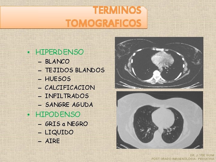 TERMINOS TOMOGRAFICOS • HIPERDENSO – – – BLANCO TEJIDOS BLANDOS HUESOS CALCIFICACION INFILTRADOS SANGRE