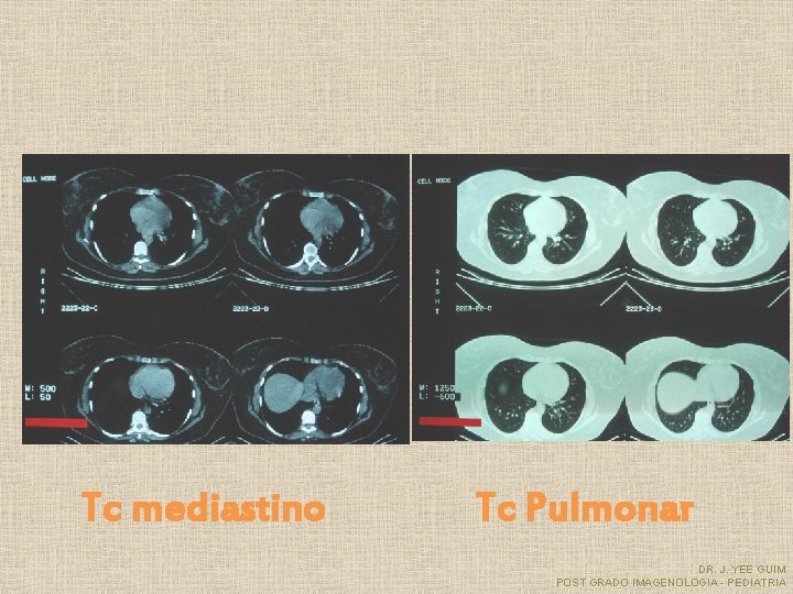 Tc mediastino Tc Pulmonar DR. J. YEE GUIM POST GRADO IMAGENOLOGIA - PEDIATRIA 