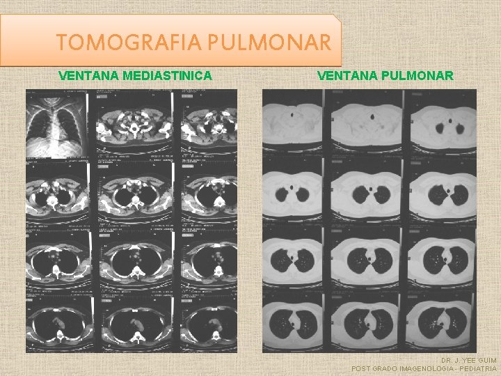 TOMOGRAFIA PULMONAR VENTANA MEDIASTINICA VENTANA PULMONAR DR. J. YEE GUIM POST GRADO IMAGENOLOGIA -