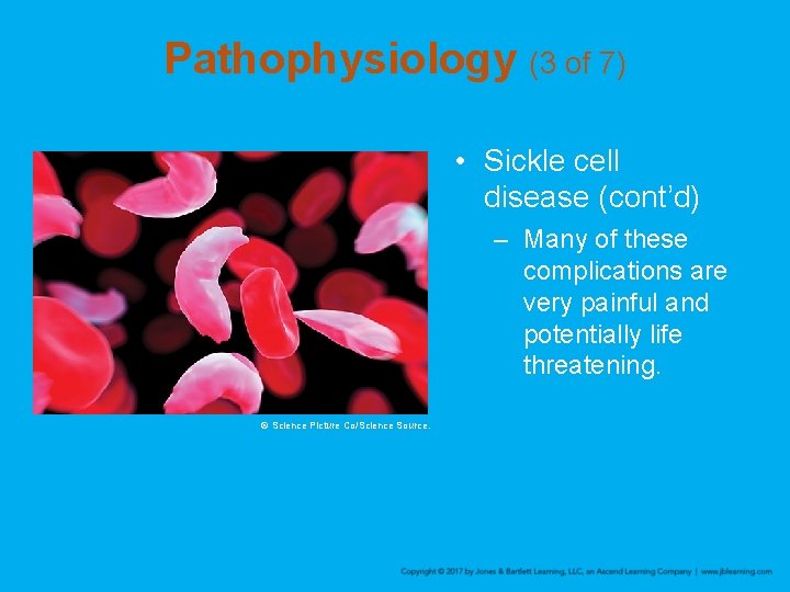 Pathophysiology (3 of 7) • Sickle cell disease (cont’d) – Many of these complications