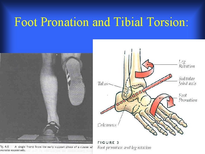 Foot Pronation and Tibial Torsion: Foot Pronation and Tibial Torsion:
