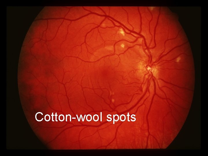 Cotton Eye Problem Tropical Ophthalmology Part One of Three Dr Steve