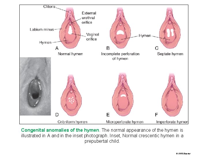 Congenital anomalies of the hymen. The normal appearance of the hymen is illustrated in