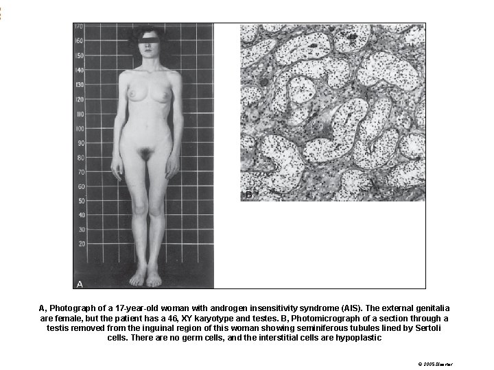 A, Photograph of a 17 -year-old woman with androgen insensitivity syndrome (AIS). The external