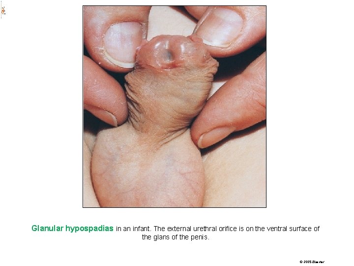Glanular hypospadias in an infant. The external urethral orifice is on the ventral surface