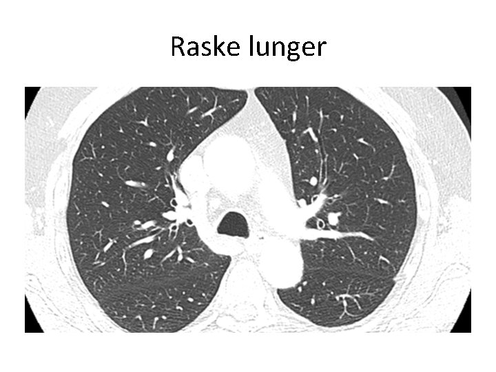 Raske lunger 