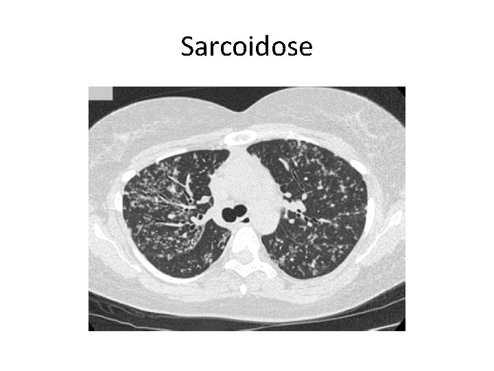 Sarcoidose 