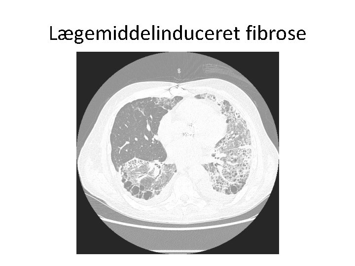 Lægemiddelinduceret fibrose 
