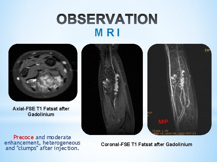 M R I Axial-FSE T 1 Fatsat after Gadolinium MIP Precoce and moderate enhancement,