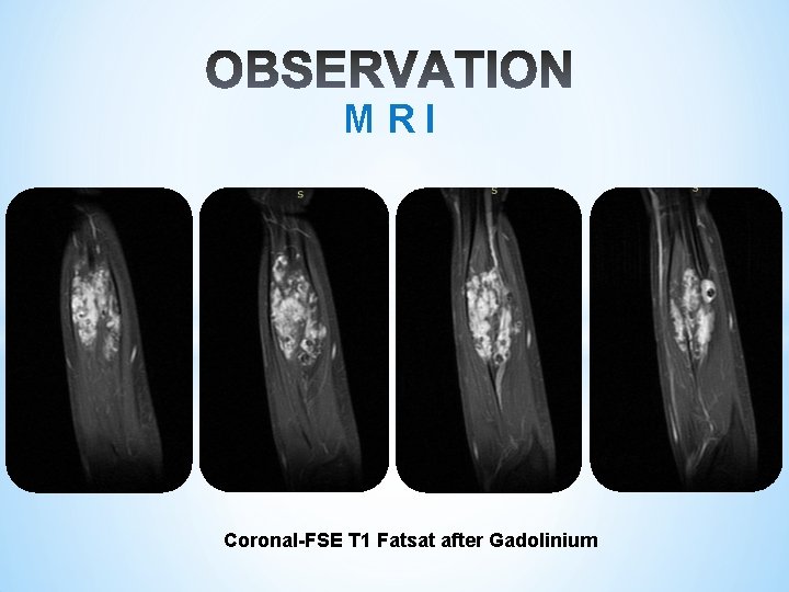 M R I Coronal-FSE T 1 Fatsat after Gadolinium 