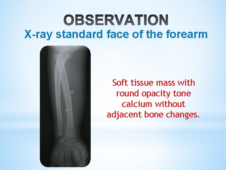 X-ray standard face of the forearm Soft tissue mass with round opacity tone calcium