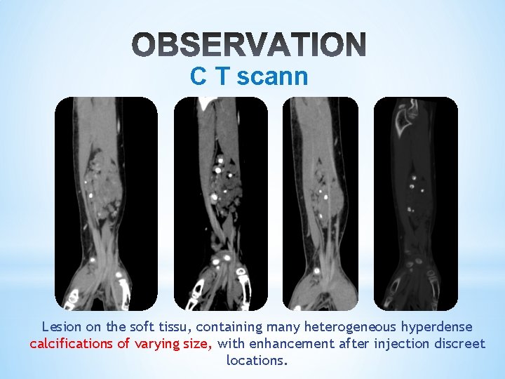 C T scann Lesion on the soft tissu, containing many heterogeneous hyperdense calcifications of