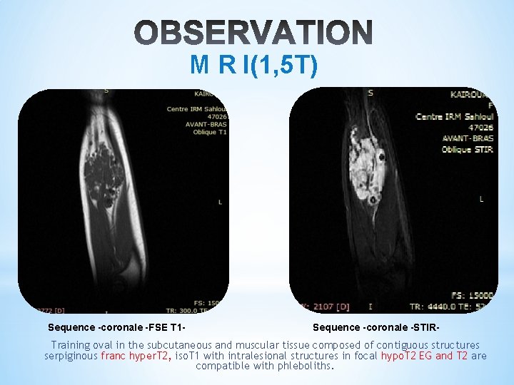 M R I(1, 5 T) Sequence -coronale -FSE T 1 - Sequence -coronale -STIR-