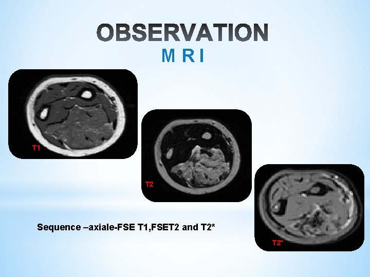 M R I T 1 T 2 Sequence –axiale-FSE T 1, FSET 2 and