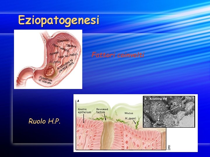 Eziopatogenesi Fattori coinvolti Ruolo H. P. 