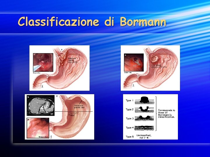 Classificazione di Bormann 