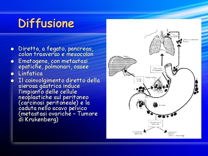 Diffusione Diretta, a fegato, pancreas, colon trasverso e mesocolon l Ematogena, con metastasi epatiche,