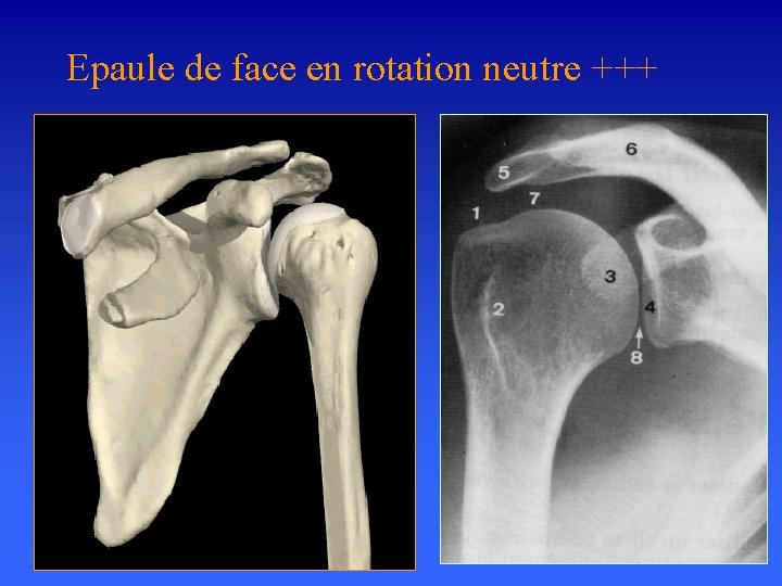 Epaule de face en rotation neutre +++ Cliché indispensable devant toute épaule rhumatologique ou