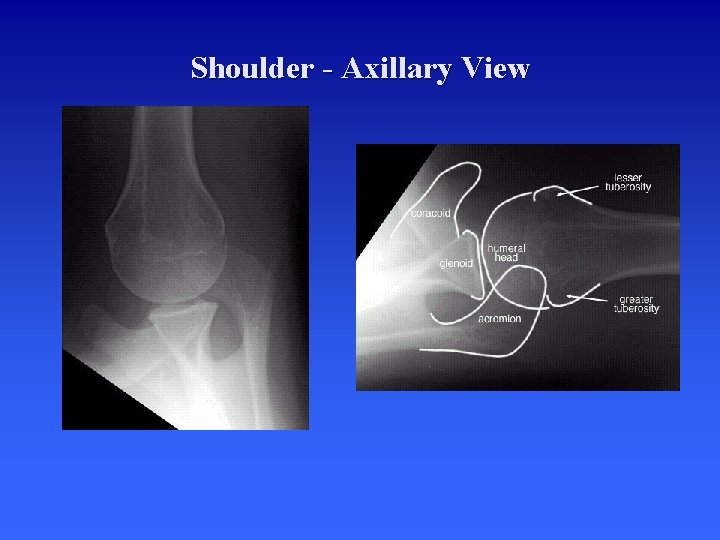 Shoulder - Axillary View 
