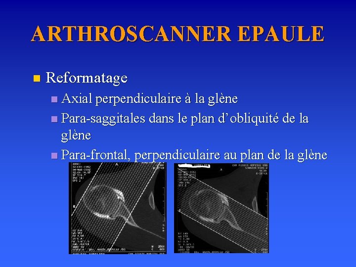 ARTHROSCANNER EPAULE n Reformatage Axial perpendiculaire à la glène n Para-saggitales dans le plan