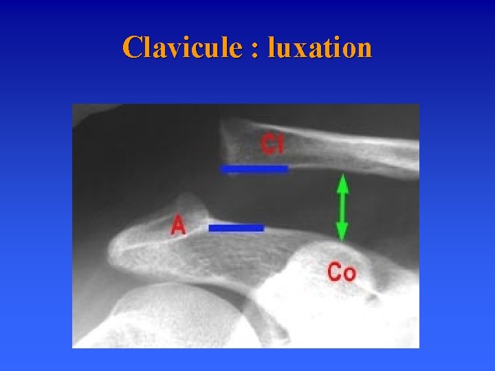 Clavicule : luxation 