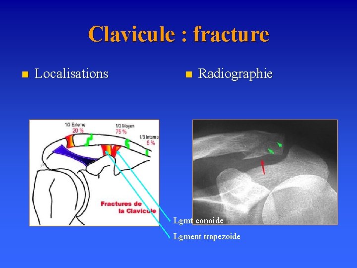 Clavicule : fracture n Localisations n Radiographie Lgmt conoide Lgment trapezoide 