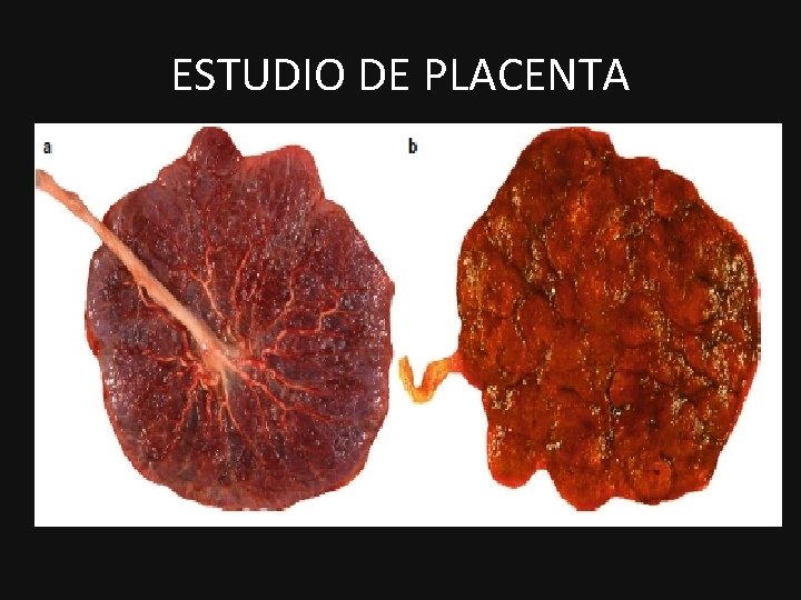 ESTUDIO DE PLACENTA 