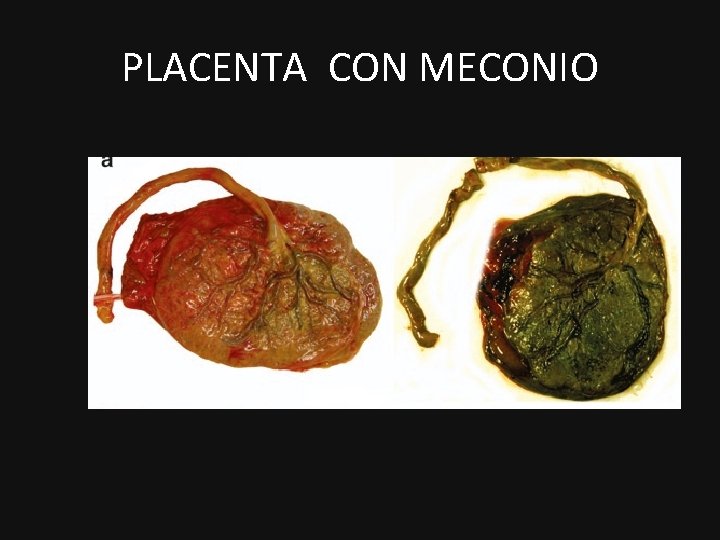 PLACENTA CON MECONIO PLACENTA CON MECONIO
