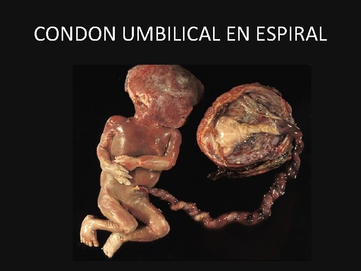 CONDON UMBILICAL EN ESPIRAL 