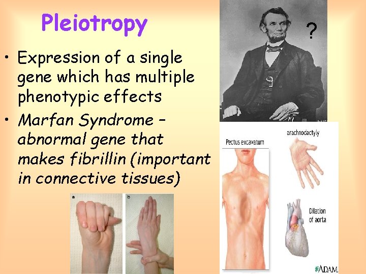Pleiotropy • Expression of a single gene which has multiple phenotypic effects • Marfan