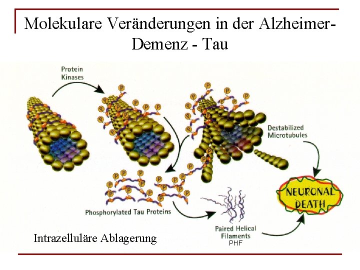 Molekulare Veränderungen in der Alzheimer. Demenz - Tau Intrazelluläre Ablagerung PHF 