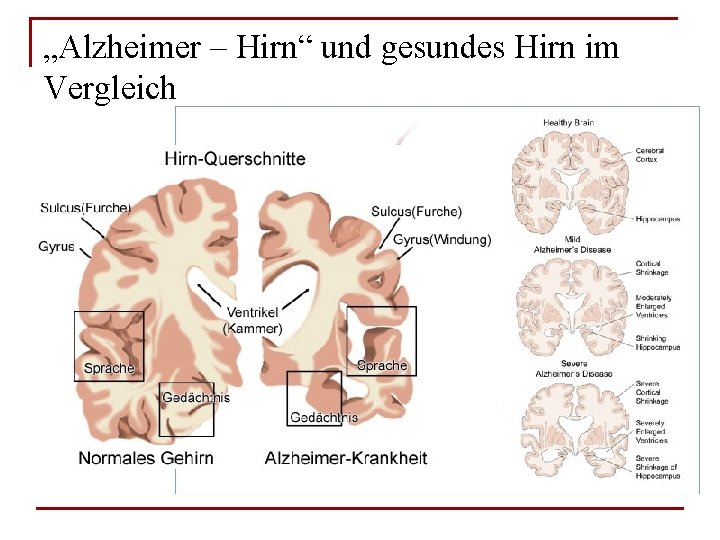 „Alzheimer – Hirn“ und gesundes Hirn im Vergleich 