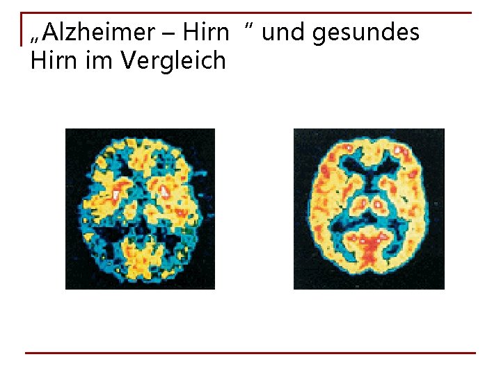 „Alzheimer – Hirn“ und gesundes Hirn im Vergleich 