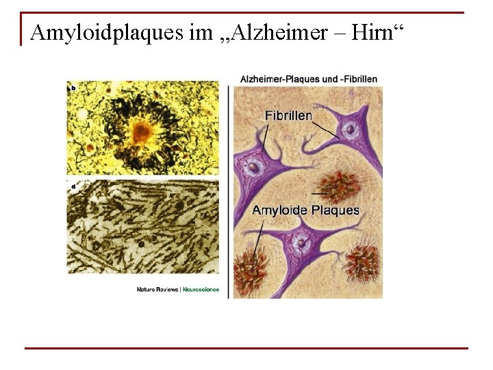 Amyloidplaques im „Alzheimer – Hirn“ 