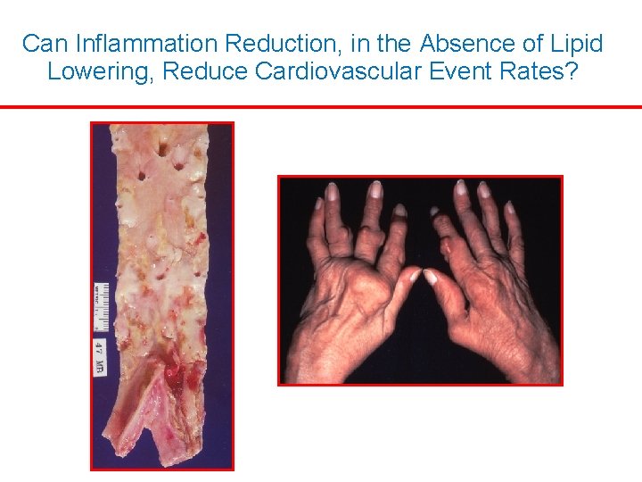 Can Inflammation Reduction, in the Absence of Lipid Lowering, Reduce Cardiovascular Event Rates? Can Inflammation Reduction, in the Absence of Lipid Lowering, Reduce Cardiovascular Event Rates?