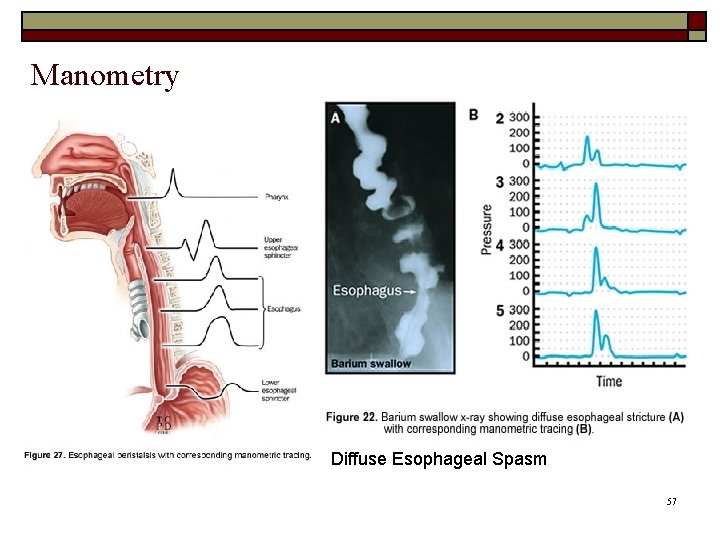 Manometry Diffuse Esophageal Spasm 57 