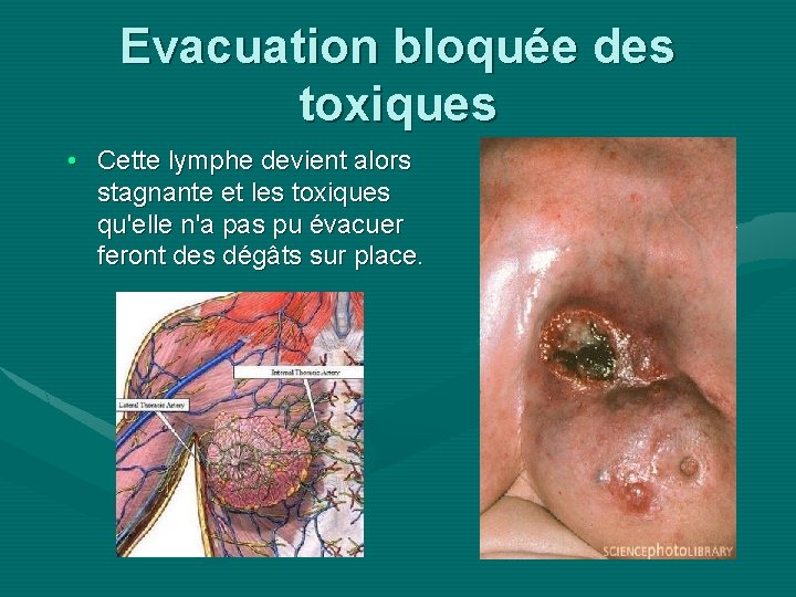 Evacuation bloquée des toxiques • Cette lymphe devient alors stagnante et les toxiques qu'elle