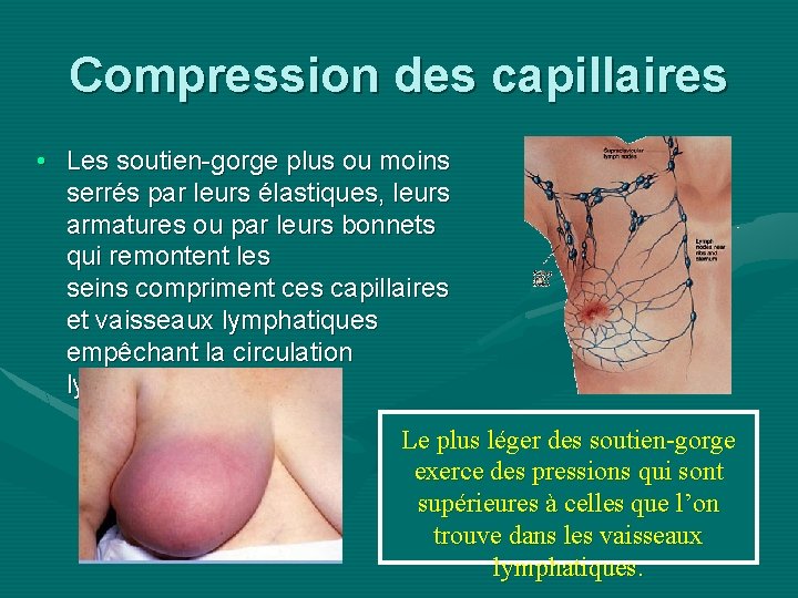 Compression des capillaires • Les soutien-gorge plus ou moins serrés par leurs élastiques, leurs