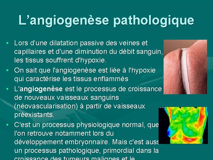 L’angiogenèse pathologique • Lors d’une dilatation passive des veines et capillaires et d'une diminution
