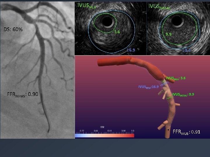 IVUSMLA DS: 60% IVUSDISTAL 3. 6 9. 9 16. 9 13. 4 FFRINVAS: 0.